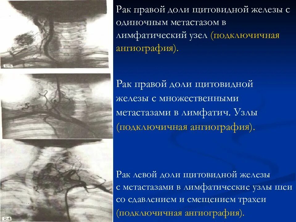 Выраженные диффузные изменения щитовидной железы. Узел правой доли щитовидной железы. фокальные изменения щитовидной железы. узел левой доли щитовидной железы. фокальные изменения щитовидной железы узи.