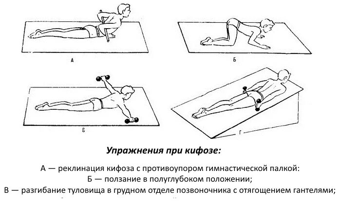 Упражнения при грудном кифозе