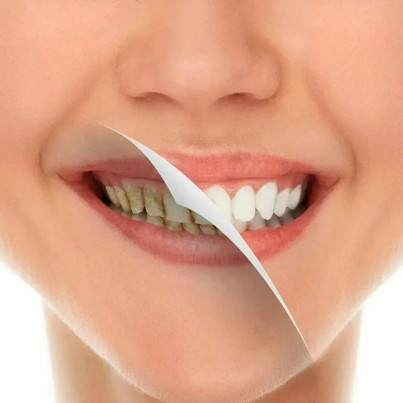 Комплексная гигиена полости рта. Профгигиена полости рта Air Flow. Профессиональная чистка зубов. Чистые зубы. Профессиональная гигиеническая чистка зубов.