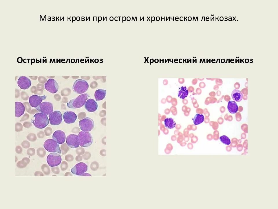 Миелобластный лейкоз характеристика. Острый и хронический миелобластный лейкоз. Острый и хронический миелолейкоз. Хронический миелолейкоз миелограмма. Хронический миелолейкоз костный мозг.