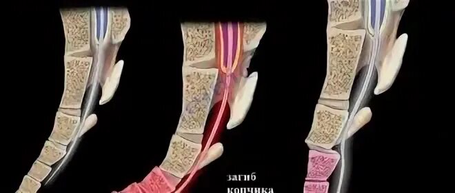 Ушибла копчик как лечить. Краевой перелом копчика.