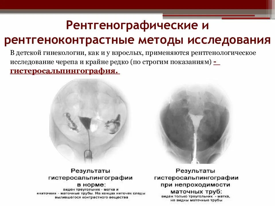 Методы исследования гинекологических. Рентгенологические методы исследования в гинекологии. рентгенологический метод исследования в гинекологии. рентгенографические методы исследования. исследование гсг в гинекологии.