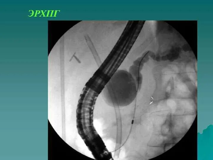 Ретроградная холангиопанкреатография ЭРХПГ. ЭРХПГ стриктура холедоха. ЭРХПГ поджелудочной железы. Стент желчного протока