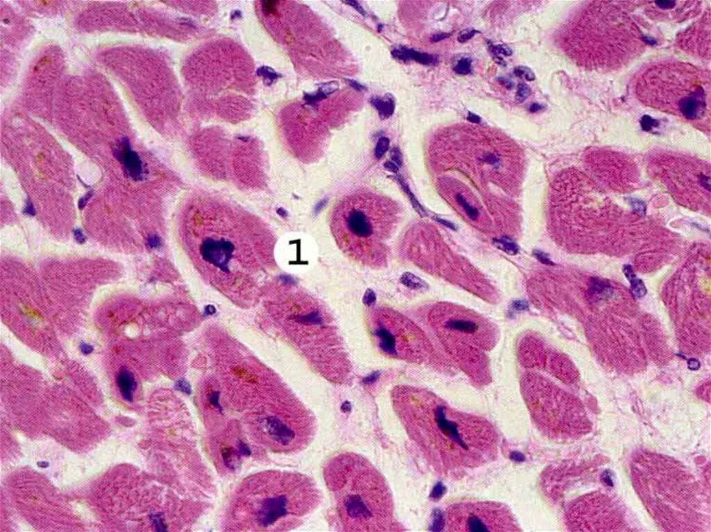 Гипертрофия миокарда гистология. Строма миокарда склерозирована. Гиперхромное ядро это гистология. Гидропическая дистрофия стромы. Клетки с гиперхромными ядрами