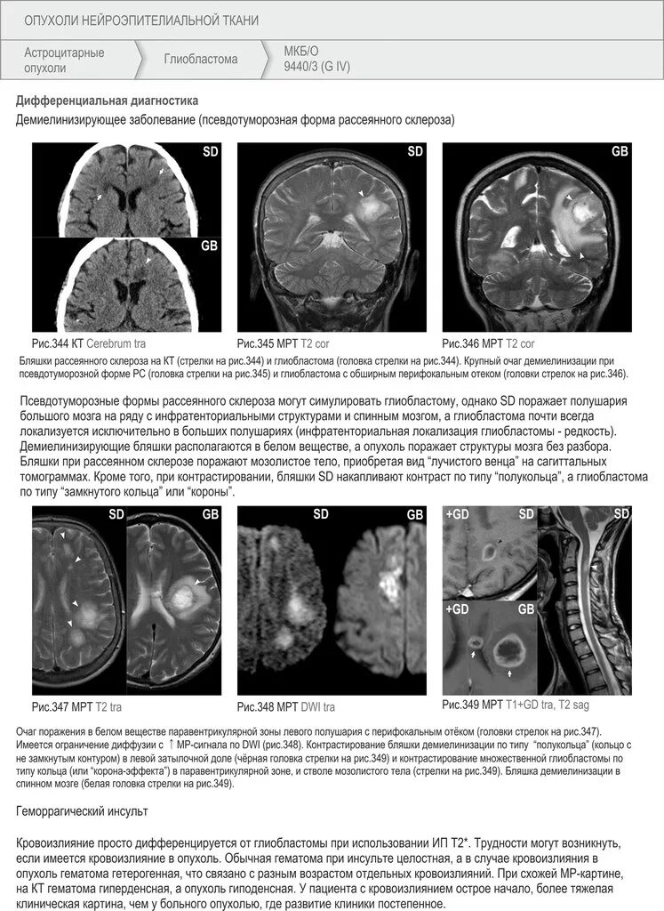 Мрт какие диагнозы. Глиобластома головного мозга мрт. Мрт с диагнозом опухоль головного мозга. Глиобластома с отеком головного мозга на кт. Кт мрт головного мозга опухоль полушария.
