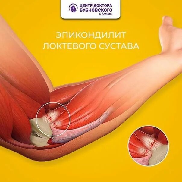 Эпикондилит локтевого сустава код по мкб 10. Эпикондилит локтевого сустава. наружный эпикондилит локтевого сустава. воспаление локтевого сустава эпикондилит. эпикондилит плечевого сустава.