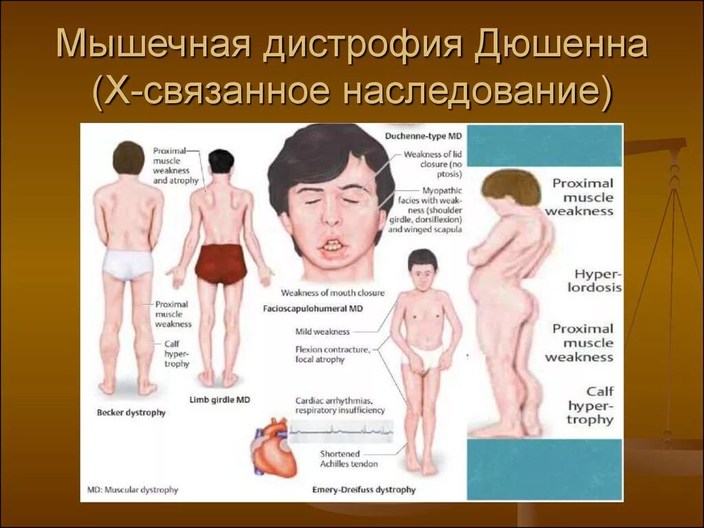 Заболевание миопатия. Синдром мышечной дистрофии Дюшенна. Миодистрофия Дюшенна болезнь. Прогрессирующая мышечная дистрофия Дюшенна симптомы. Дистрофия Дюшенна Тип наследования.