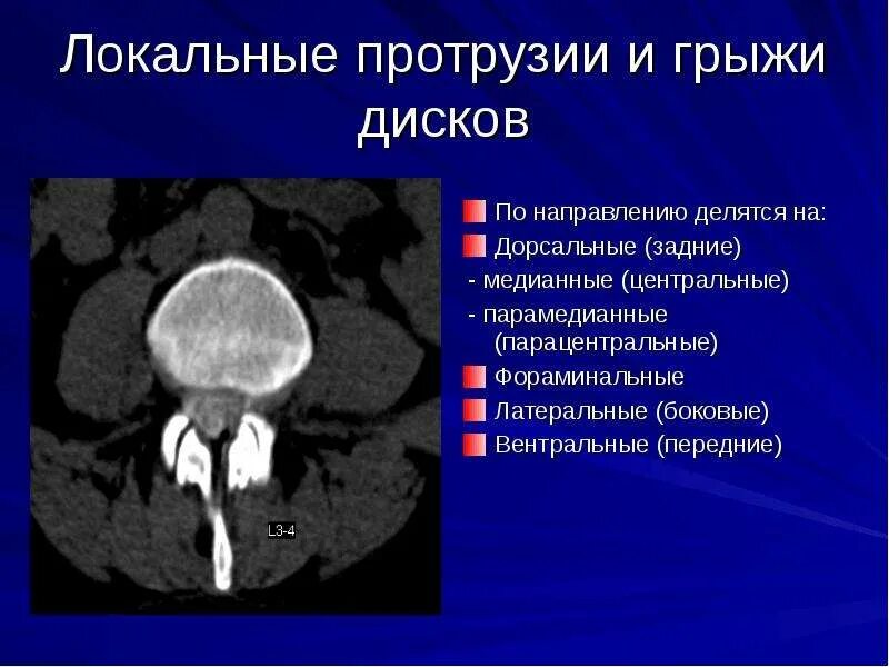 Медианно парамедианная билатеральная. Протрузия межпозвонковых дисков кт. Задняя медиальная протрузия диска. Грыжа медианная формамиальгая. Грыжа диска на кт.