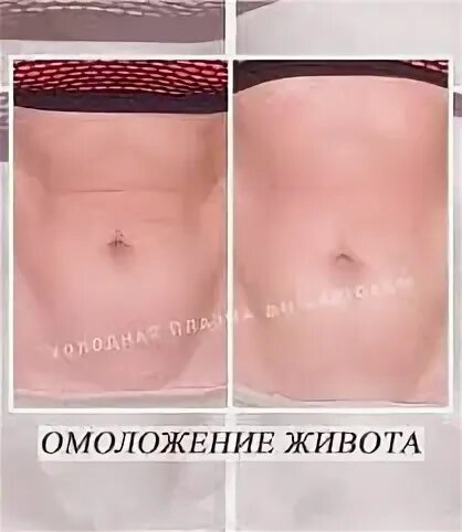 Интимное омоложение до и после