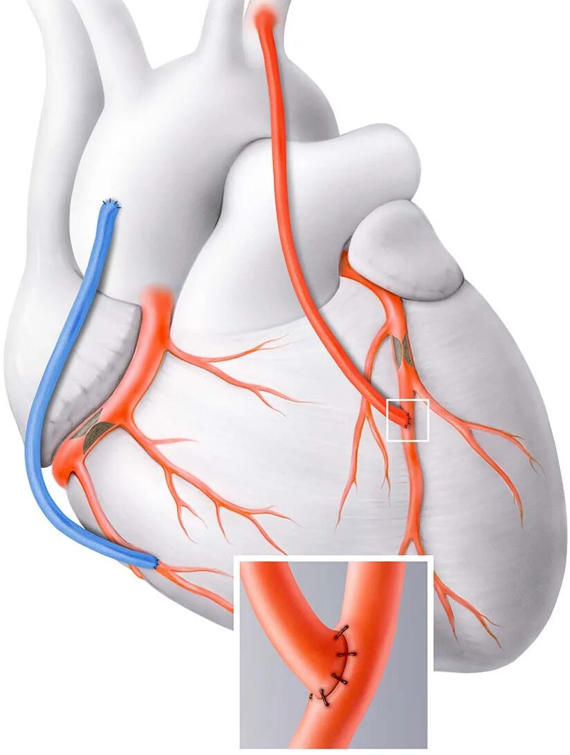 Операция через сосуды. Маммарокоронарное шунтирование. Коронарное шунтирование сосудов сердца. Схема операции аортокоронарного шунтирования. Аорто коронарное шунтирование сосудов сердца.