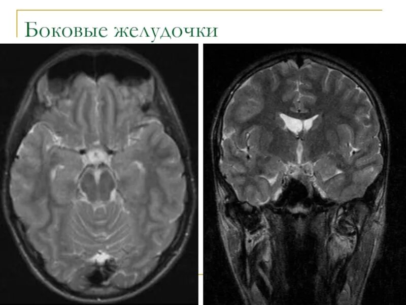 Боковые желудочки головного мозга на мрт. Боковые желудочки головного мозга кт. Боковые желудочки головного мозга анатомия. 3 Желудочек головного мозга норма кт. Расширение боковых рогов