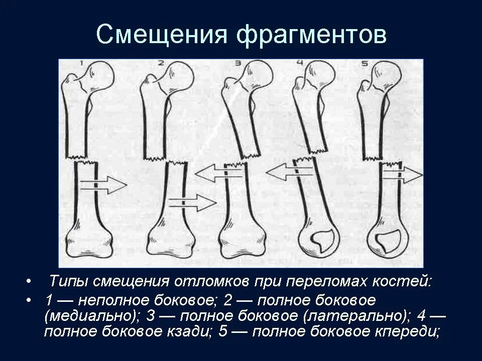 Вторичное смещение при переломе. Смещение фрагментов бедренной кости при переломах. диафизарные переломы бедренной кости. типы смещения отломков при переломах. классификация переломов по смещению отломков.
