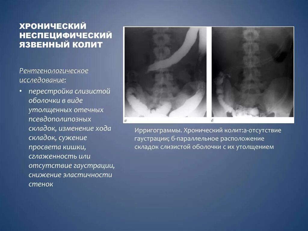 Няк что это за болезнь. Хронический колит рентгенодиагностика. Хронический колит кишечника на рентгене. Неспецифический язвенный колит рентгенодиагностика. Некротизирующий язвенный колит.