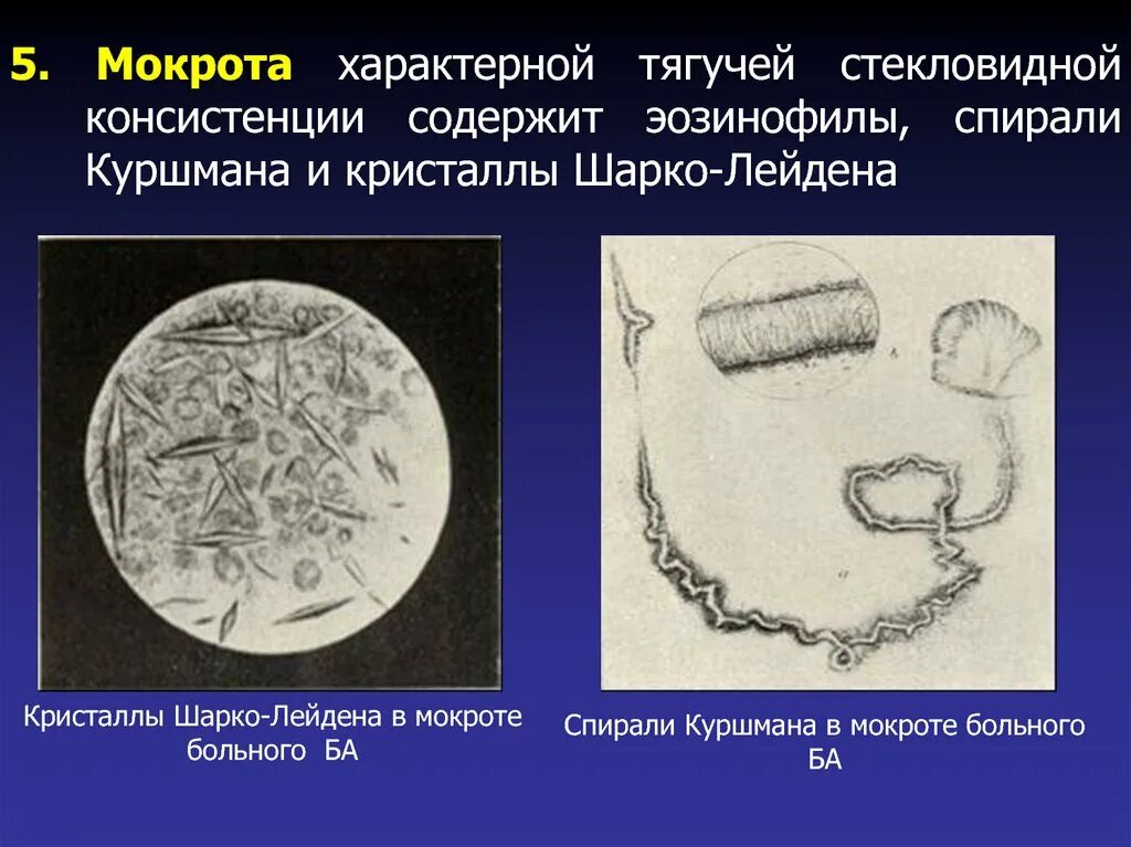 Кристаллы куршмана в мокроте. Спирали Куршмана и Кристаллы Шарко-Лейдена. Спирали Куршмана и Кристаллы Шарко-Лейдена в мокроте. Кристаллы Шарко-Лейдена в мокроте. Спирали Куршмана, Кристаллы Шарко-Лейдена, эозинофилы.