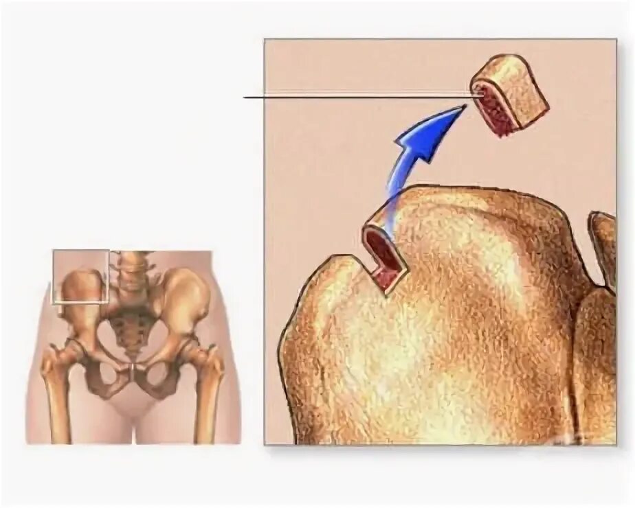 Костный мозг подвздошной кости. Биопсия костного мозга бедренной кости. Трепан биопсия подвздошной кости. Взятие трансплантата из подвздошной кости.