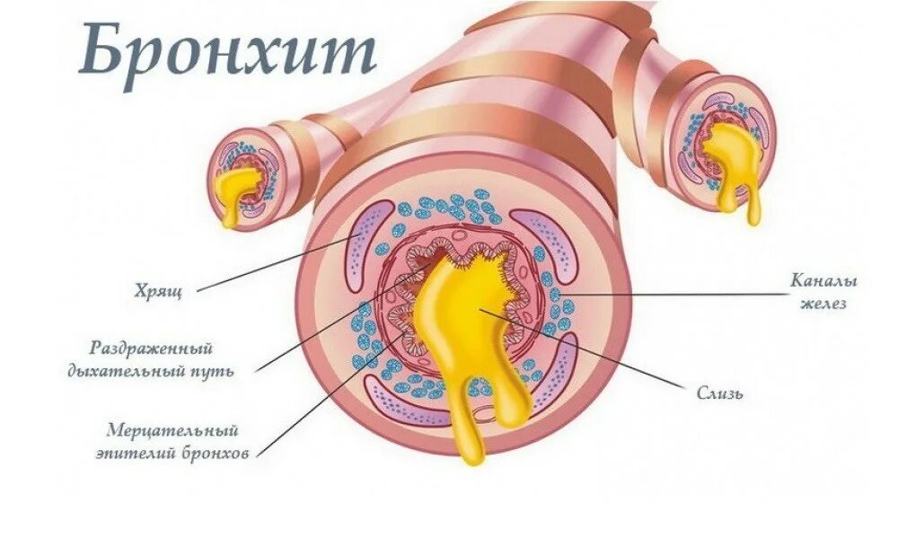 Это бронхит на целлюлит на