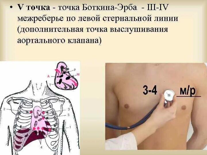 Аускультация точки Боткина Эрба. Аускультация сердца точка Боткина Эрба. 5 Точка аускультации сердца Боткина. Аускультация в точке Боткина. Клапаны сердца на грудной клетке