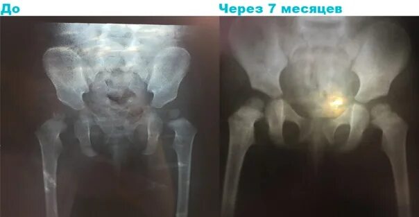 Дисплазия бедренной кости. Дисплазия тазобедренных суставов у ребенка 1 год. Дисплазия вертлужных впадин. Дисплазия тазобедренного сустава буклет. Сосудистая дисплазия у детей.