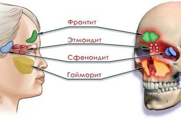 Синусит фронтит этмоидит. Этмоидит (воспаление решетчатой пазухи). Пазухи носа гайморит синусит.