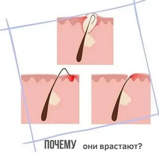 Депиляция воском вросших волос