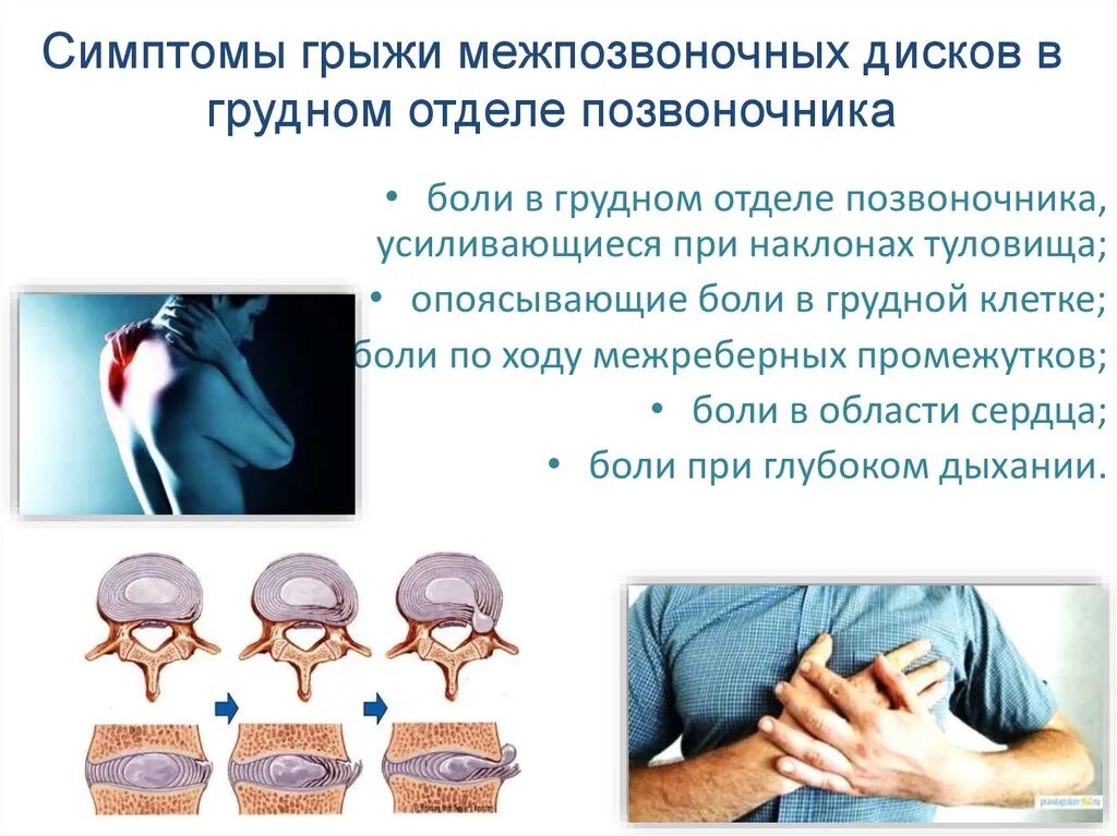 Грыжи поясничного отдела позвоночника у женщин. Грыжа грудного отдела позвоночника симптомы. Проявления грыжи в позвоночнике. Грыжа позвоночника симптомы. Межпозвоночная грыжа симптомы.