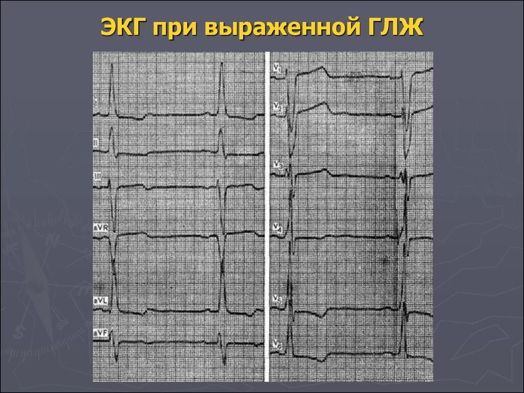 Гипертрофия миокарда лж что это. Гипертрофия левого желудочка на ЭКГ. Гипертрофия лж на ЭКГ. ЭКГ при гипертрофии лж. Гипертрофия миокарда лж на ЭКГ.