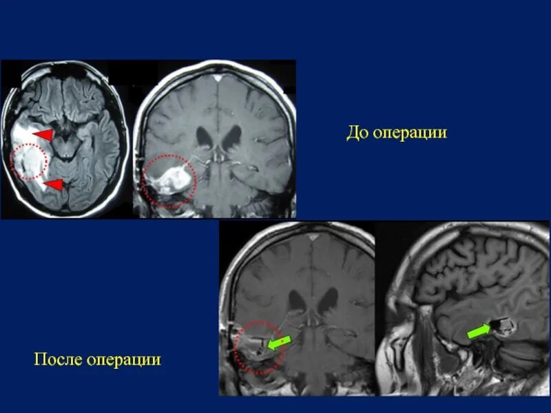 Отек головного мозга операции. Опухольмозага операция. опухоль головного мозга операция. операция на головном мозге.