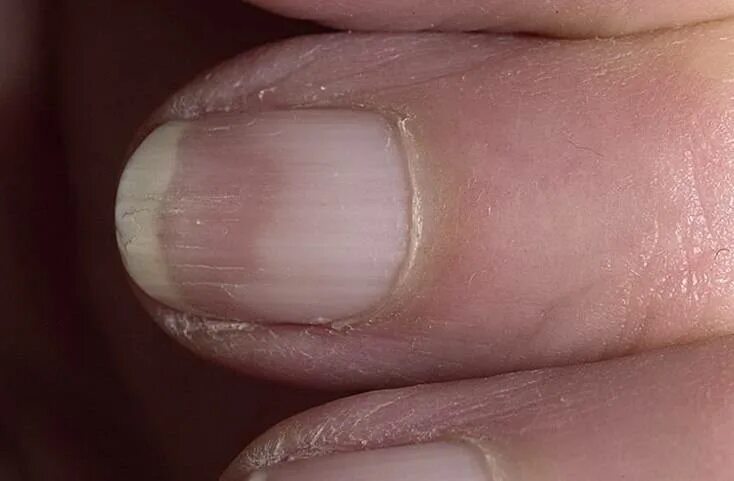 Почему ногти пахнут. Половинчатые ногти Терри. Онихорексис онихомикоз. Нормотрофический онихомикоз. Ониходистрофия (дистрофия ногтей).