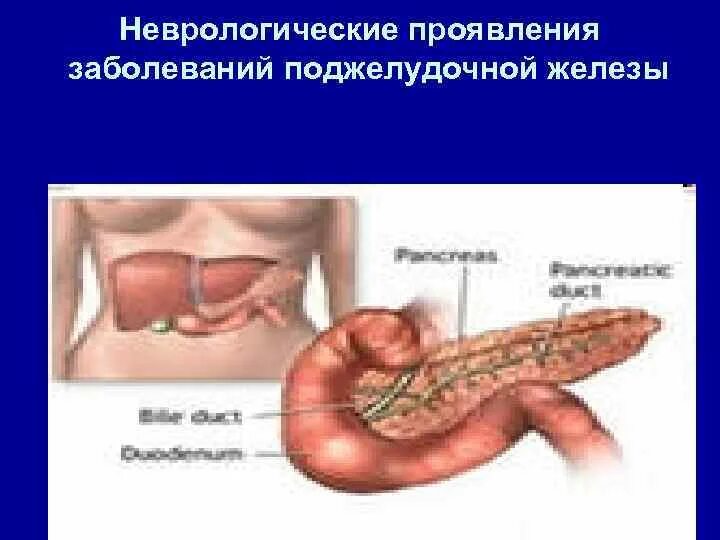 Симптомызаболеваничподжелудочноцэелезы. Поджелудочная железа симптомы заболевания. Симптомы болезни поджелудочной. Поражение поджелудочной железы. Панкреатит поджелудочной железы у женщин как лечить