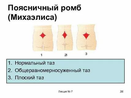 Ромб михаэлиса размеры