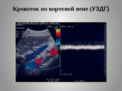 Узи кровотока