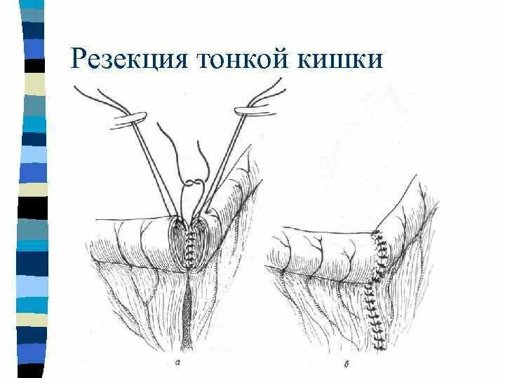 Какие операции делают прямой кишки. Резекция тонкой и толстой кишки. резекция тонкой кишки (этапы, виды межкишечных анастомозов). схема операции резекции тонкой кишки.