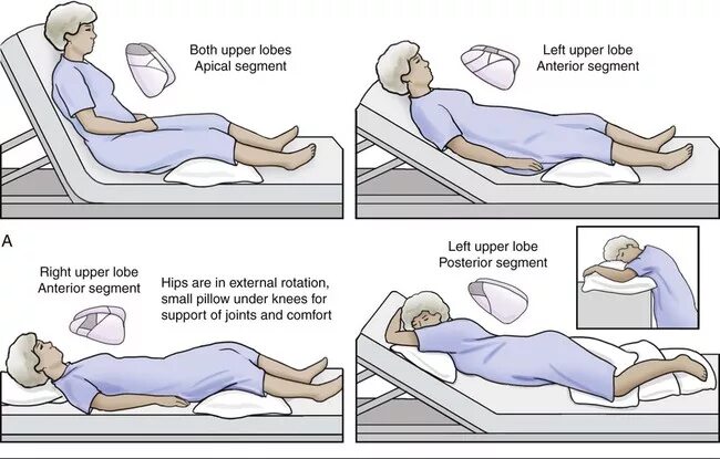 Мокрота у лежачих. Дренажное положение для отхождения мокроты у лежачих больных. Постуральный дренаж бронхоэктатической болезни. Дренажное положение при бронхите. Дренажное положение при бронхиальной астме.