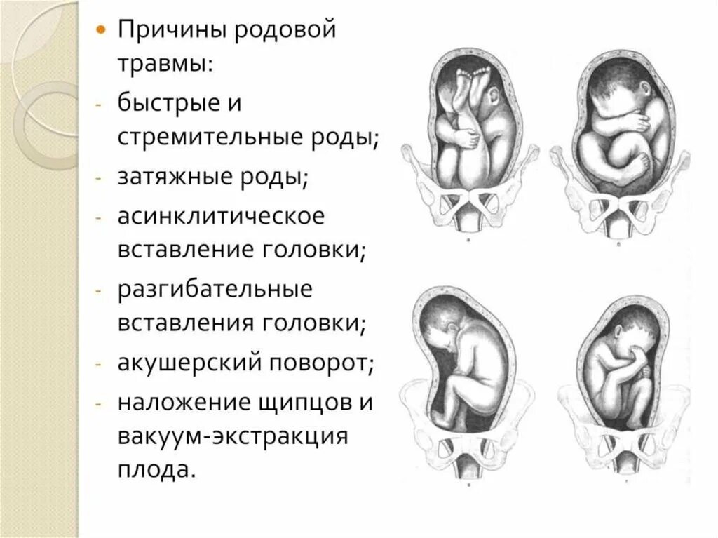 Разгибательные предлежания плода. Разгибательные предлежания головки плода. Передний вид лицевого предлежания. Задний вид лицевого предлежания. Переднеголовное предлежание