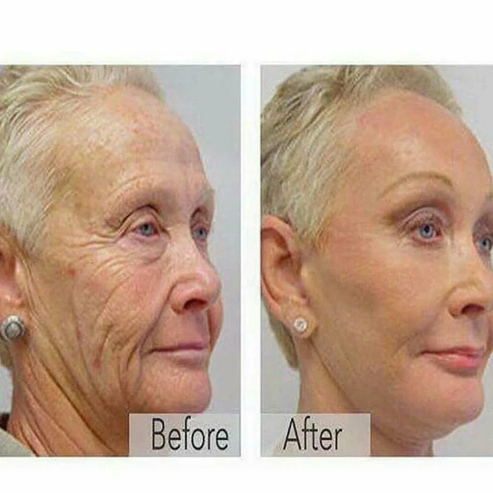 Брыли на лице ботокс. Диспорт в носогубные складки. Ботулинотерапия лифтинг нефертити. Ботокс от брылей отзывы. Ботокс от брылей отзывы.