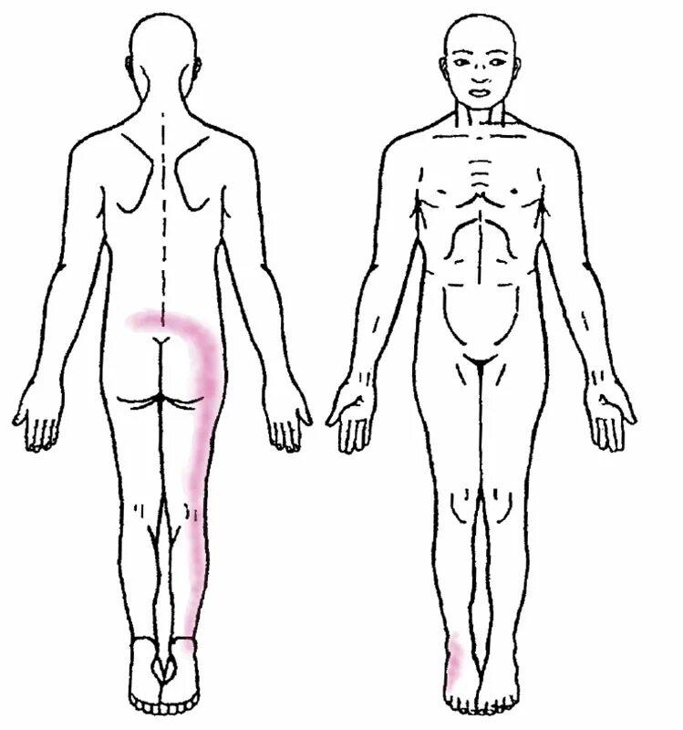 Люмбоишиалгия карта вызова. Синдром люмбоишиалгии. Клинические проявления люмбоишиалгия. Схема лечения люмбоишиалгии. Люмбоишиалгия, мышечно-тонические.