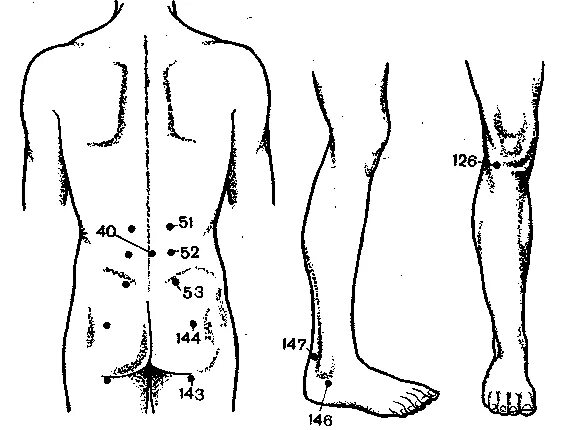 Точки на пояснице. Акупунктурные точки при радикулите. Схема постановки пиявок при воспалении седалищного нерва. Точечный массаж седалищного нерва. Точки рефлексотерапии защемление седалищного нерва.