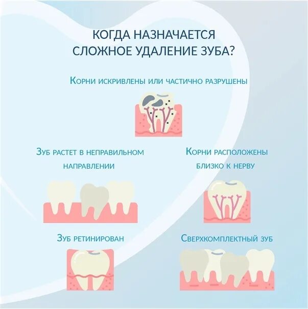 В какие дни удалять зубы. Удаление постоянного зуба сложное. Какие зубы сложно удалять.