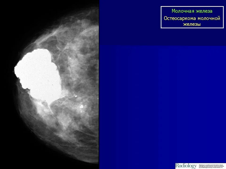 Саркома на узи. Саркома молочной железы. Остеосаркома молочной железы. Остеосаркоз молочной железы. Ангиосаркома молочной железы.