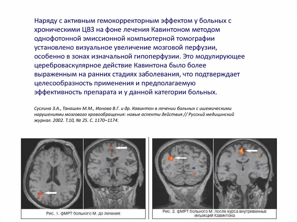 Признаки дисциркуляторных изменений. Дисциркуляторная энцефалопатия на кт. Дисциркуляторная энцефалопатия головного мозга на кт. Стадии энцефалопатии головного мозга кт. Дисциркуляторная энцефалопатия на мрт заключение.