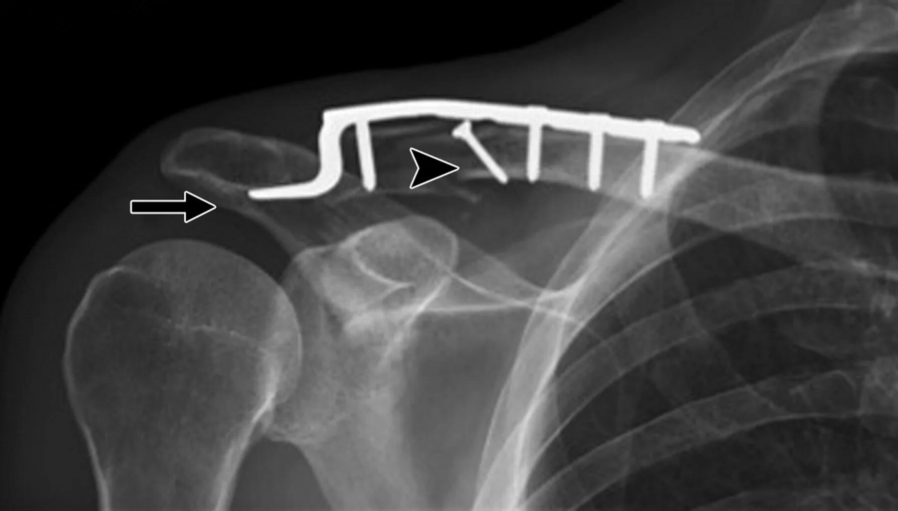 Остеосинтез операция пластины. Перелом ключицы остеосинтез пластиной. Остеосинтез крючковидной пластиной. Остеосинтез акс крючковидной пластиной. Остеосинтез разрыва акс.