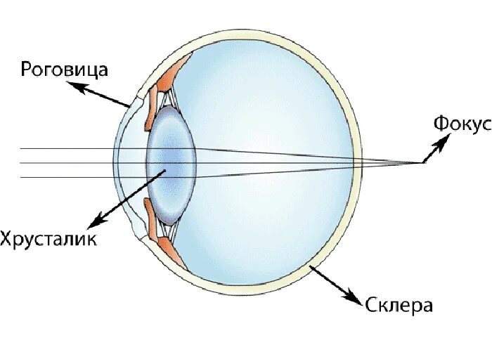 Дальнозоркость роговица. Гиперметропия схема глаза. Дальнозоркость и близорукость строение глаза. Глаз при дальнозоркости. К оптической системе глаза относятся роговица хрусталик