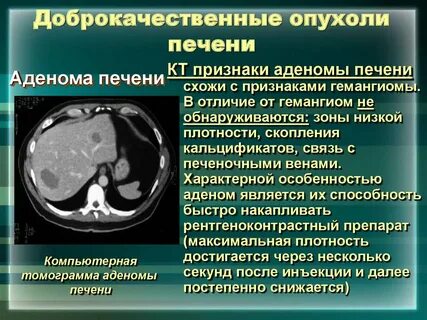 Злокачественное новообразование печени
