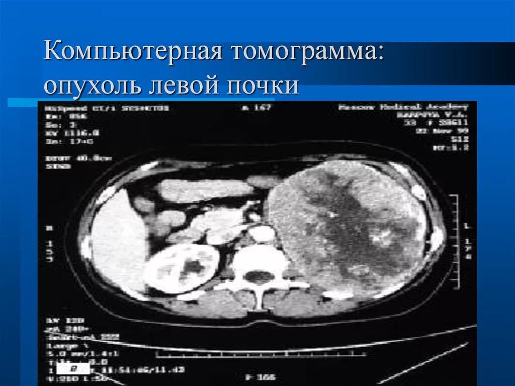 Опухоль почки на компьютерной томографии. Кт снимки опухоль почки. На кт видно опухоль