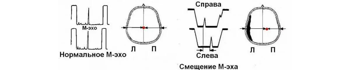 Эхо гостомеля. Эхо ЭГ норма. Эхоэнцефалоскопия расшифровка результатов. Эхоэнцефалограмма головы расшифровка. ЭХОЭГ эхоэнцефалография расшифровка.