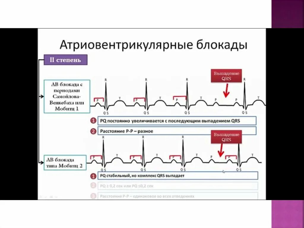 Блокада сердца опасно для жизни. Степени атриовентрикулярной блокады на ЭКГ. АВ блокада 1 степени на ЭКГ. Атриовентрикулярная блокада 2:1 ЭКГ. АВ блокада 2 степени Мобитц 3.