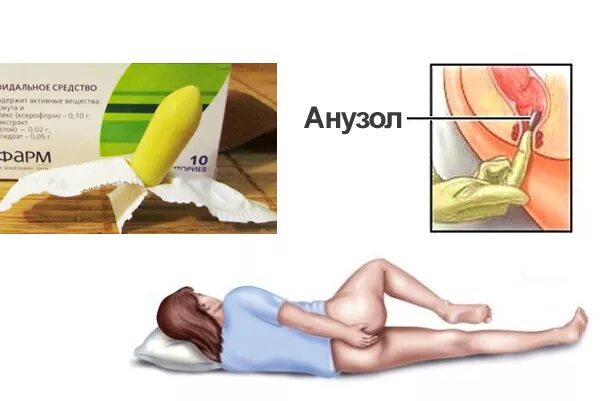 Что такое ректальное введение свечей. Как лежать после свечки. Методика введения ректальных свечей. Как лежать после свечки. Лежачая поза при геморрое.