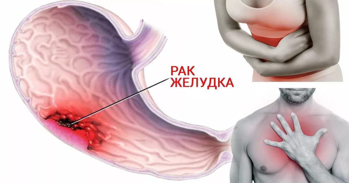 Онкология желудка симптомы. Злокачественное новообразование желудка. Опухолевые заболевания желудка.