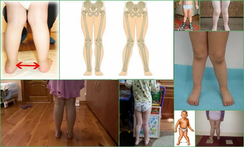 Одна нога другой короче и глаз. Вальгусная деформация х образные ноги. Рекурвация коленного сустава.