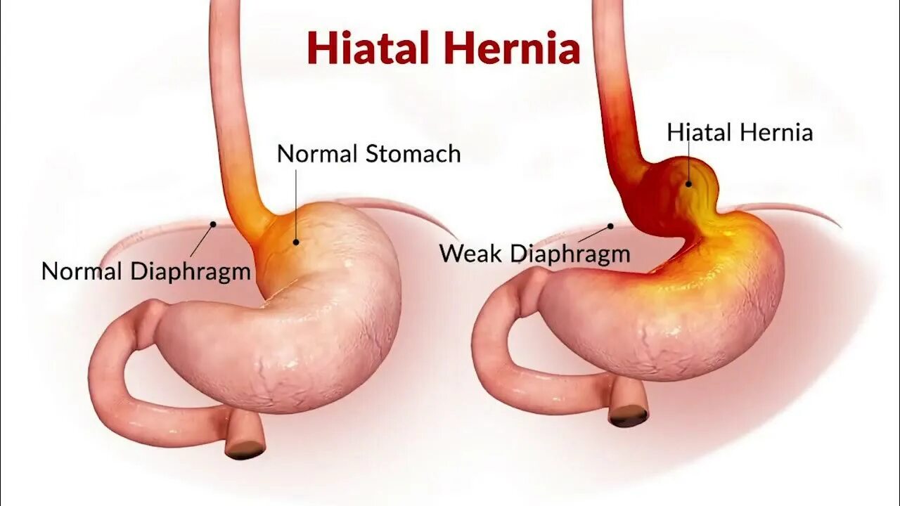 Грыжа пищеводного отверстия причины. Грыжа пищевода симптомы симптомы. Хиатальная пищеводная грыжа. Грыжа в пищеварительном тракте.